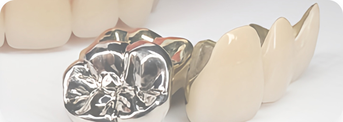 白い歯の詰め物・被せ物